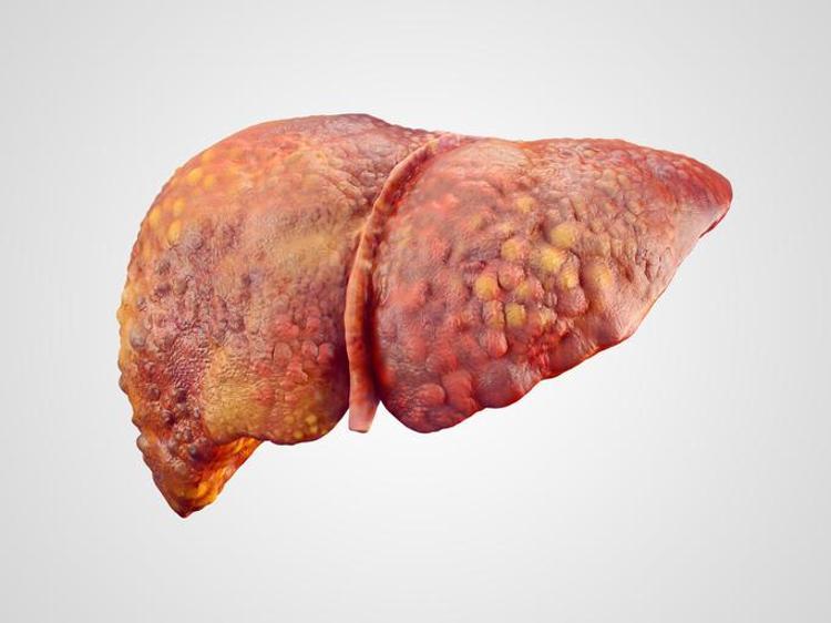 Otoimmün hepatit: