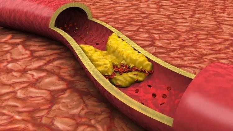 50 gramı kalbinizi saat gibi işletiyor Bu formül, yüksek kolesterolü düşürmek için, düşük yoğunluklu lipoprotein (LDL) düzeylerini azaltmaya yardımcı oluyor