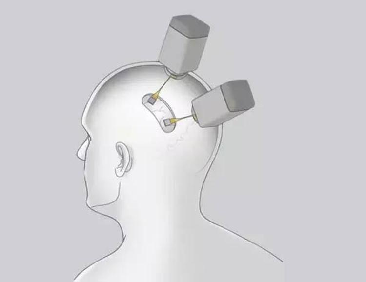 Neuralink beyin çipi nedir