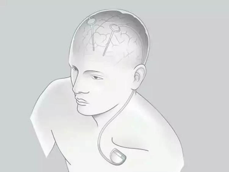 Neuralink beyin çipi nedir Neuralink ne işe yarar, Neuralink çipi nasıl çalışıyor Elon Musk Neuralink projesi