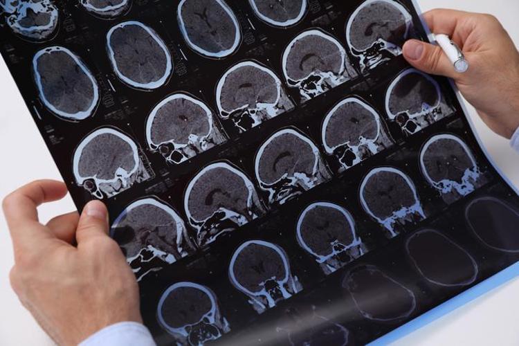 Epilepsi genci yaşlısı demiyor 20’li ve 60’lı yaşlara dikkat