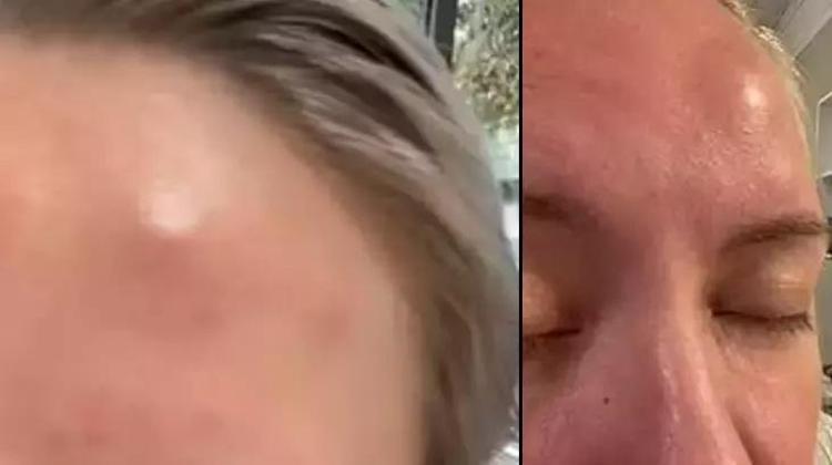 Yaptırdığı botoks 8 yıl sonra bile başına iş açtı Şişlikler herkesi dehşete düşürdü