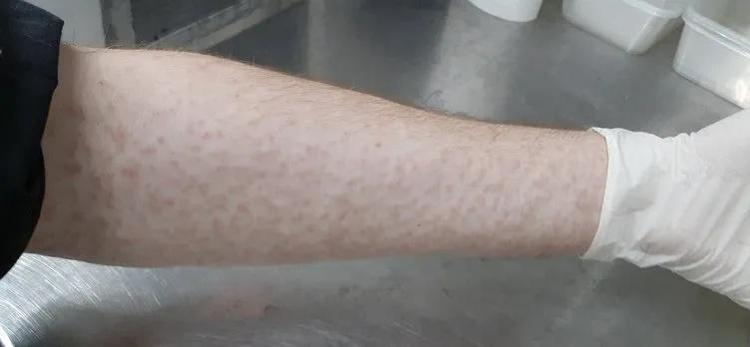 Herkes sivrisinekten kaçar ama bir doktor ısırmasına izin veriyor Sivrisinekleri koluyola besliyor Nedenini şöyle açıkladı