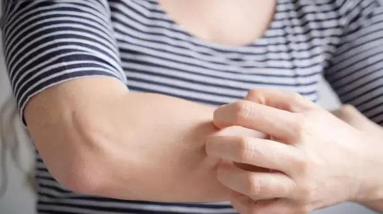 Sinek ısırığını anında geçiren tüyo; Gece uykusunu zehir eden kaşıntı sürer sürmez geçiyor
