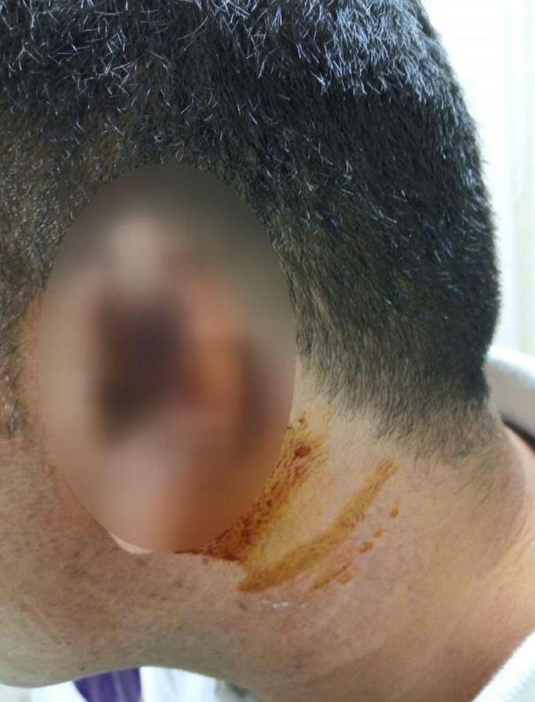 Kadına şiddete müdahale etti Kavgada ısırılarak koparılan kulağını martı kaptı