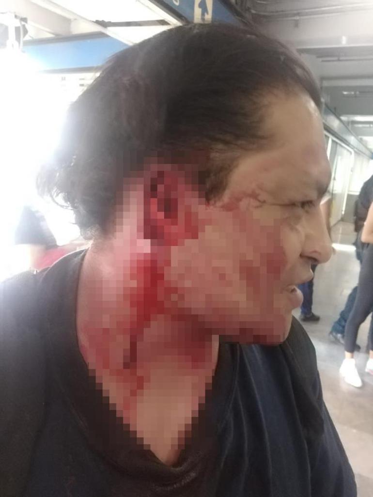 Metroda kan donduran olay Yolcunun kulağını kopardı