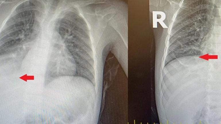 3 yıl boyunca denemediği tedavi kalmamıştı, nefes borusundan çıktı Doktorları bile şaşırtan vaka