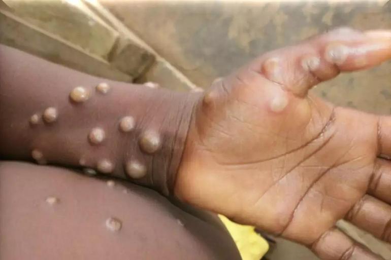 Monkeypox virüsünün yol açtığı mpox hastalığı nedeniyle Afrika ülkelerinde hayatını kaybeden sayısı git gide artıyor. Virüs, çiçek hastalığı ile aynı grupta yer alıyor. İlk olarak hayvanlardan insanlara bulaşan virüs, artık insandan insana bulaşır hale geldi.