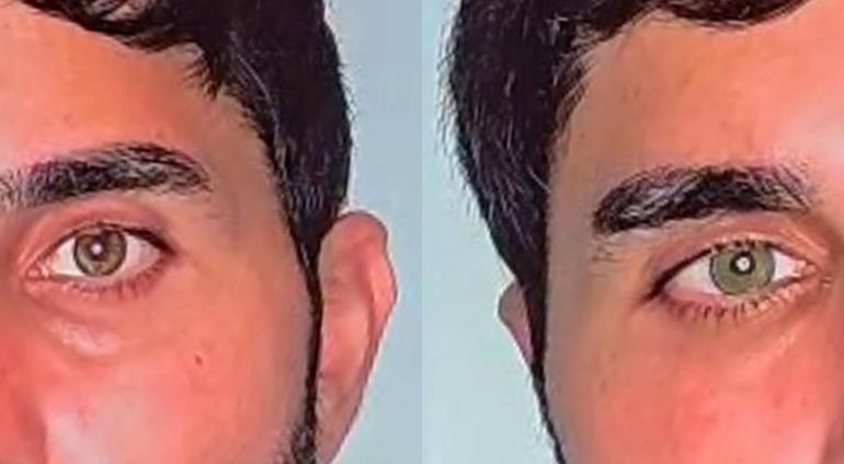 Göz rengini değiştirmek bir ameliyatla mümkün Lazer destekli yeni yöntemler kalıcı sonuç veriyor
