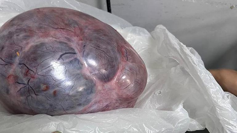 Trabzonda kadının yumurtalıklarından çıkan kitle doktorları bile şoke etti 9 kilo ağırlığında 40 santim uzunluğunda