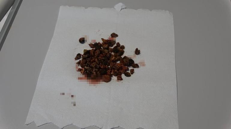 Ağrı şikayetiyle hastaneye gitti Doktorlar dondu kaldı: 100 tane birden çıktı