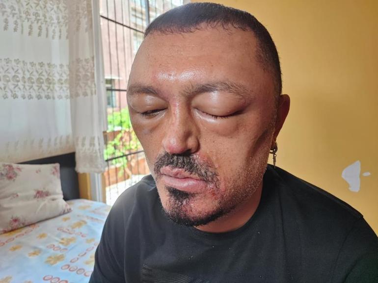 Berber tavsiyesi hayatını kabusa çevirdi İnternetten satın aldı, yüzü tanınmayacak hale geldi