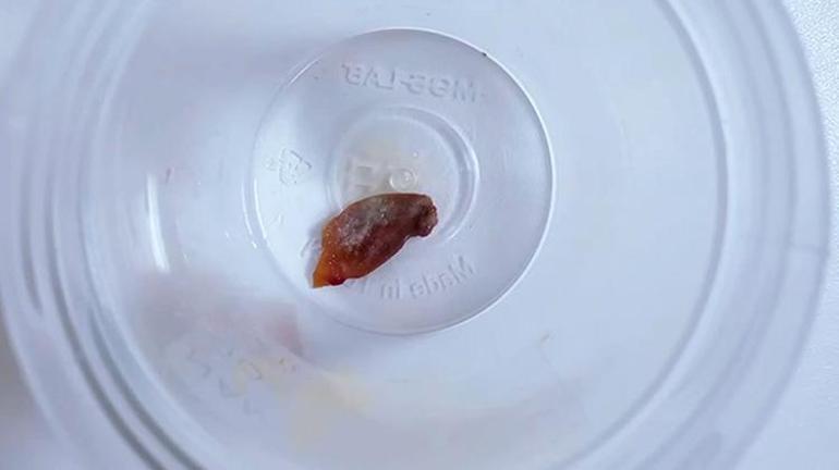 Malatyada bir buçuk yıldan beri öksüren hastanın akciğerinde kabak çekirdeği bulundu