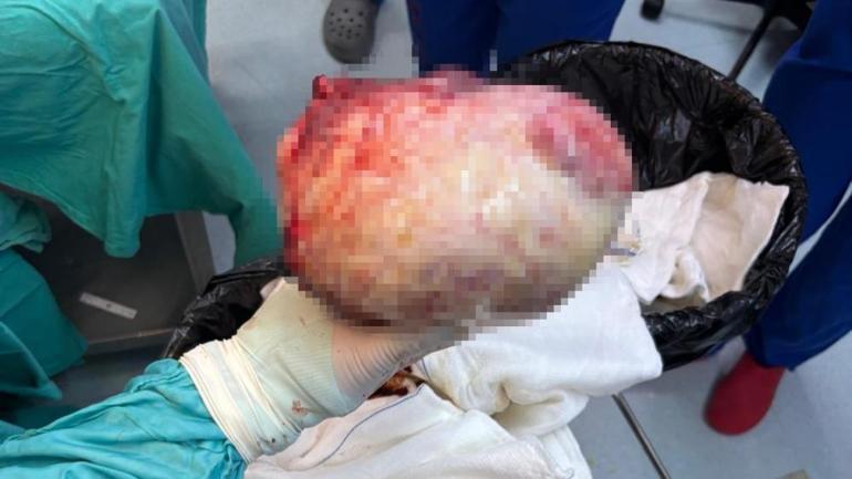 60 yaşındaki kadın hamileyim sandı Hastanede doktorlar inanamadı, tam 6 kilo çıktı