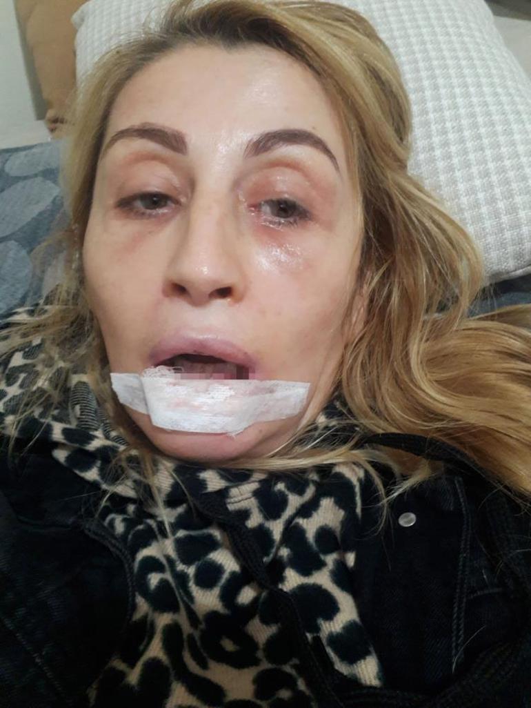 Estetik yaptırdı hayatı karardı İşlem sonrası dudağı çürüdü, 7 yıldır çare arıyor