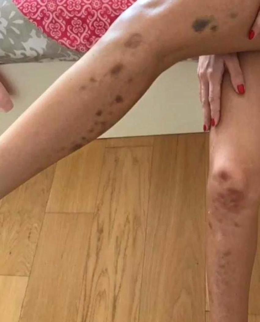 İrem Derici'nin hastalığı bu hale getirmişti!