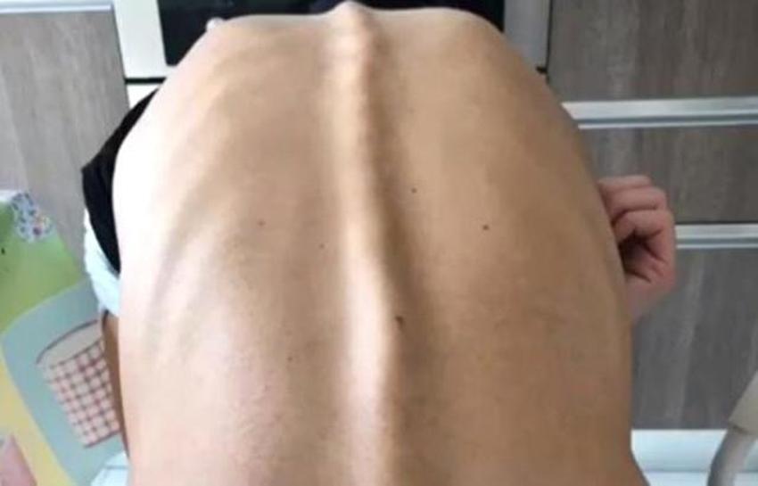 İrem Derici'nin hastalığı bu hale getirmişti!