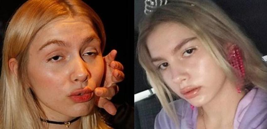 17 yaşındaki Aleyna Tilki'den dudaklarına operasyon!