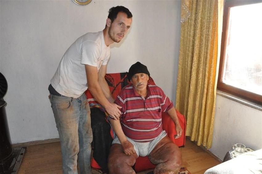 Fil hastalığı bacaklarını bu hale getirdi