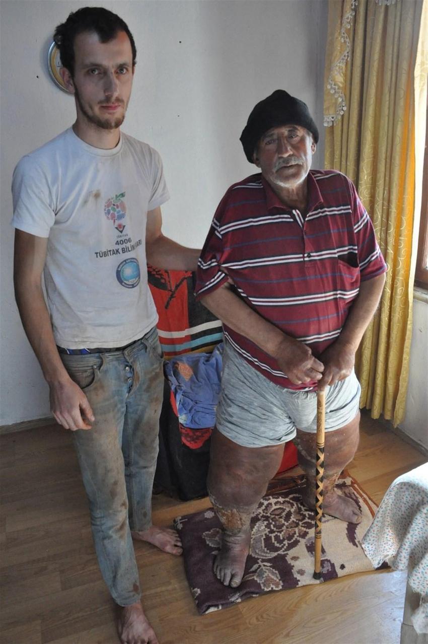 Fil hastalığı bacaklarını bu hale getirdi