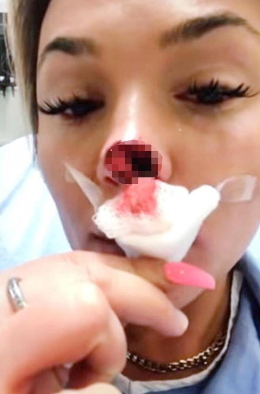Kıskançlık krizi kavgaya dönüştü! Sevgilisinin burnunu yedi
