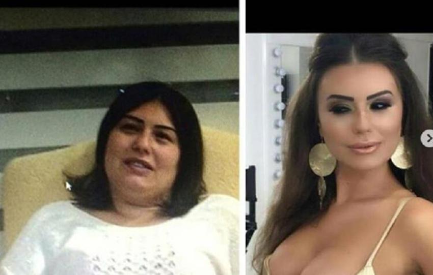2 çocuk annesi kadın 22 estetik operasyon için 240 bin TL harcadı!
