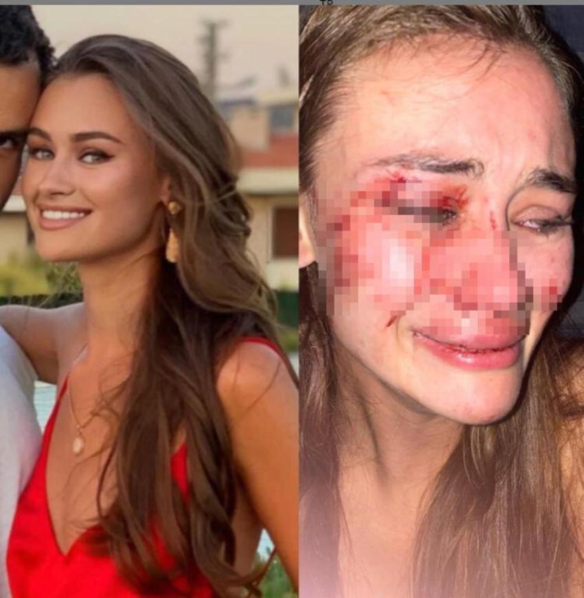 Daria Kyryliuk’un darp olayında sürpriz gelişme! Sevgilisi mi dövdü?