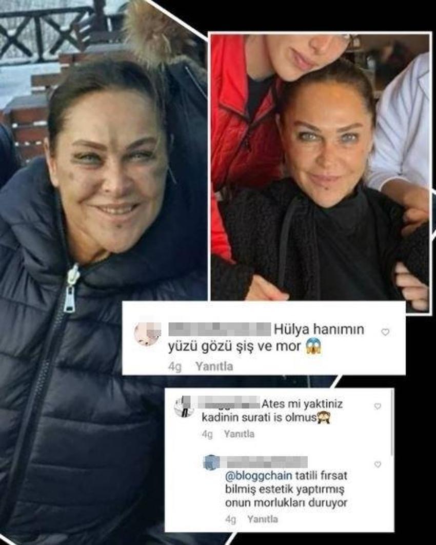 Hülya Avşar'ın yüzüne ne oldu? Morlukların sebebi...