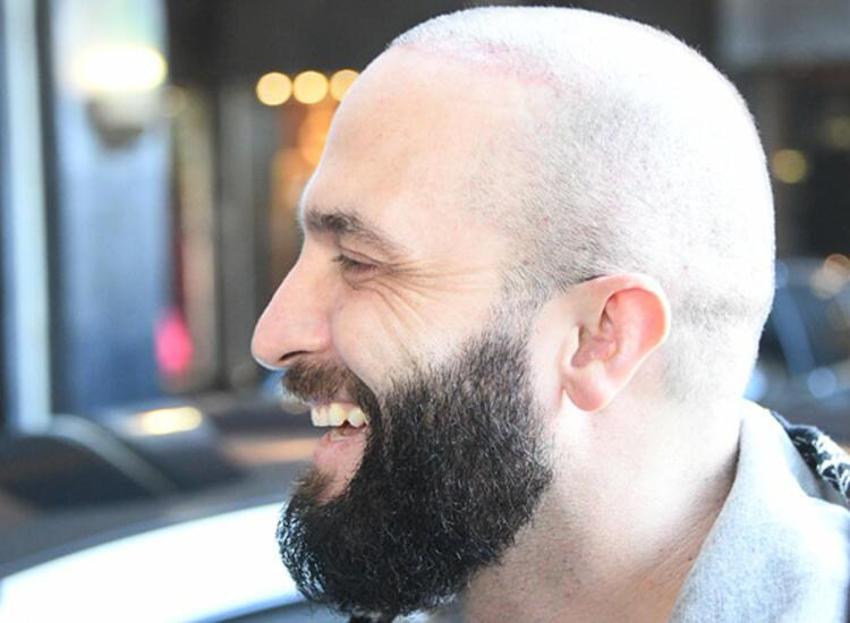 Berkay saç ektirdi: Nasıl olmuş?