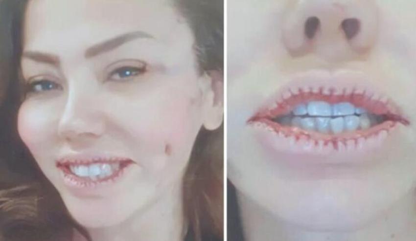 Lara pişmanlığını gözyaşları içinde anlattı! 'Dudağımla pipet bile tutamıyorum'