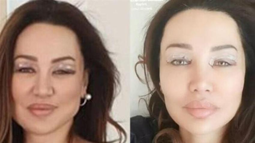 Serap Paköz '“Benim neyim eksik' dedi! İşte estetikli ünlü isimler!
