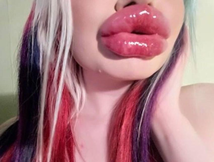 Barbie’ye özenip 20’den fazla dudak dolgusu yaptırdı