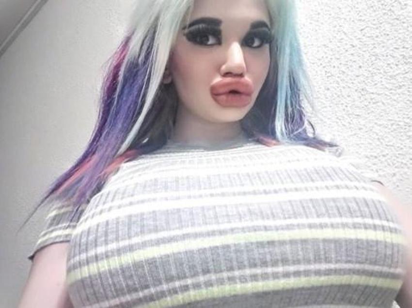 Barbie’ye özenip 20’den fazla dudak dolgusu yaptırdı