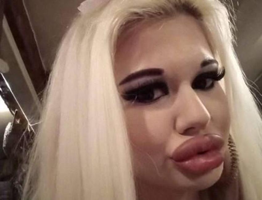 Barbie’ye özenip 20’den fazla dudak dolgusu yaptırdı