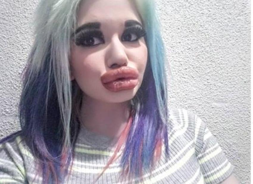 Barbie’ye özenip 20’den fazla dudak dolgusu yaptırdı