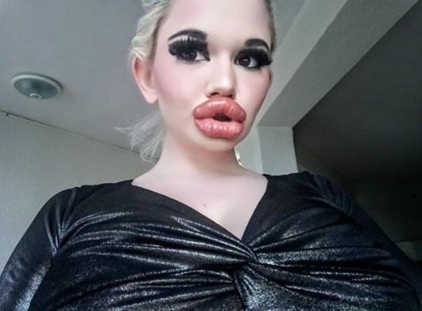 Barbie’ye özenip 20’den fazla dudak dolgusu yaptırdı