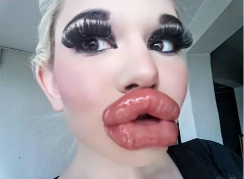 Barbie’ye özenip 20’den fazla dudak dolgusu yaptırdı
