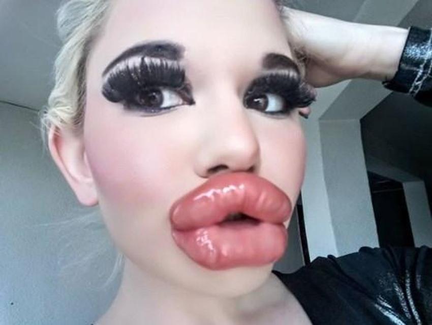 Barbie’ye özenip 20’den fazla dudak dolgusu yaptırdı