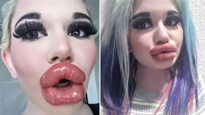 Barbie’ye özenip 20’den fazla dudak dolgusu yaptırdı