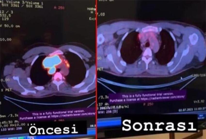 Boğaç Aksoy'un sağlık durumu ile ilgili son dakika açıklaması!
