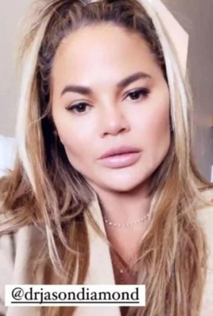 Chrissy Teigen yanaklarındaki yağları aldırdı