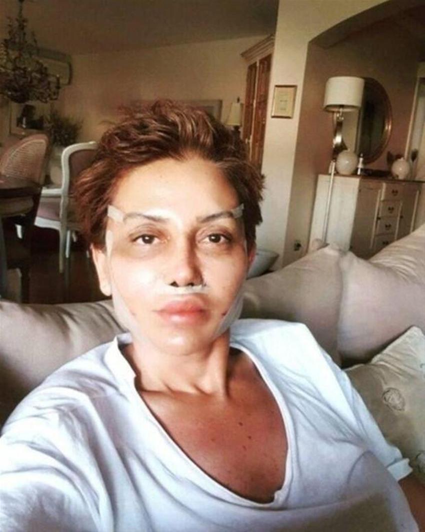 Serap Paköz estetik sonrası ilk kez paylaştı! Son hali...