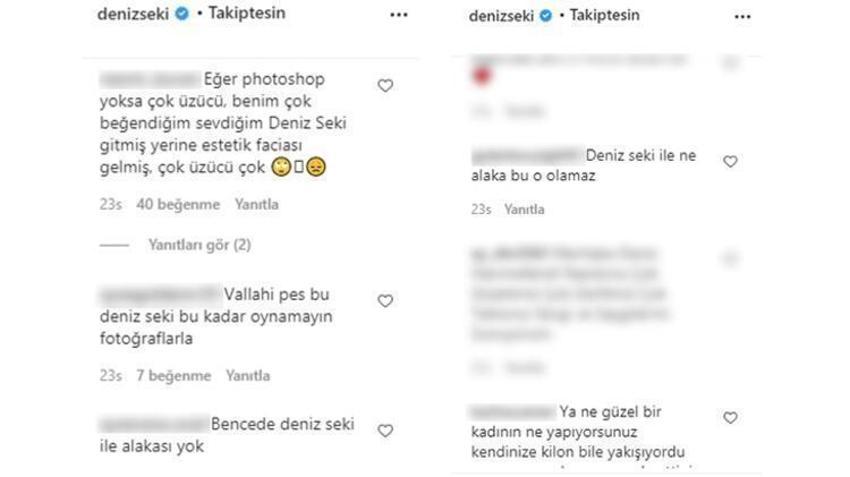 Deniz Seki yüzündeki şişliğin sebebini açıkladı!