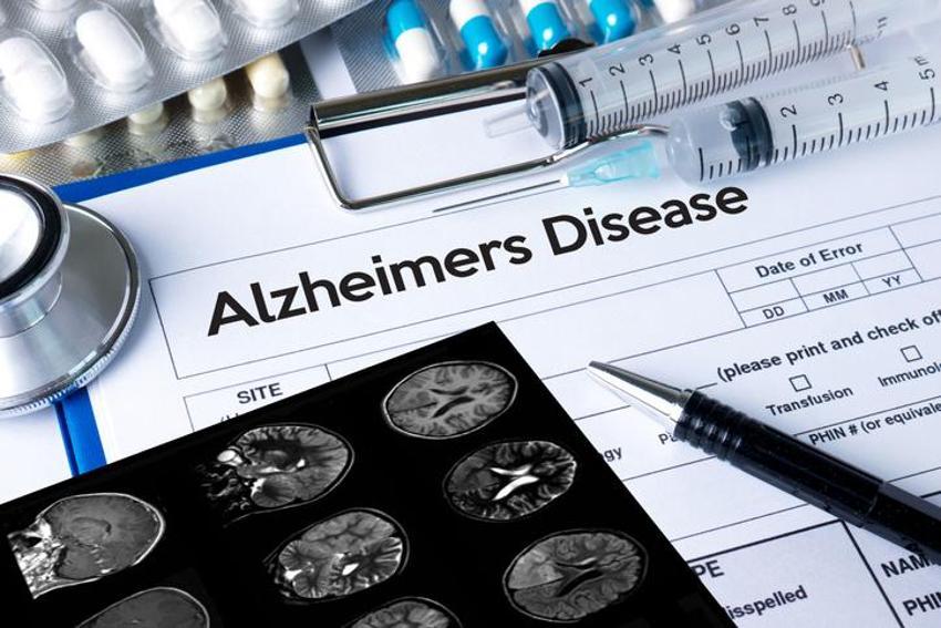 Alzheimer’ın 12 alarm belirtisi! 30 yıl önce başlıyor...