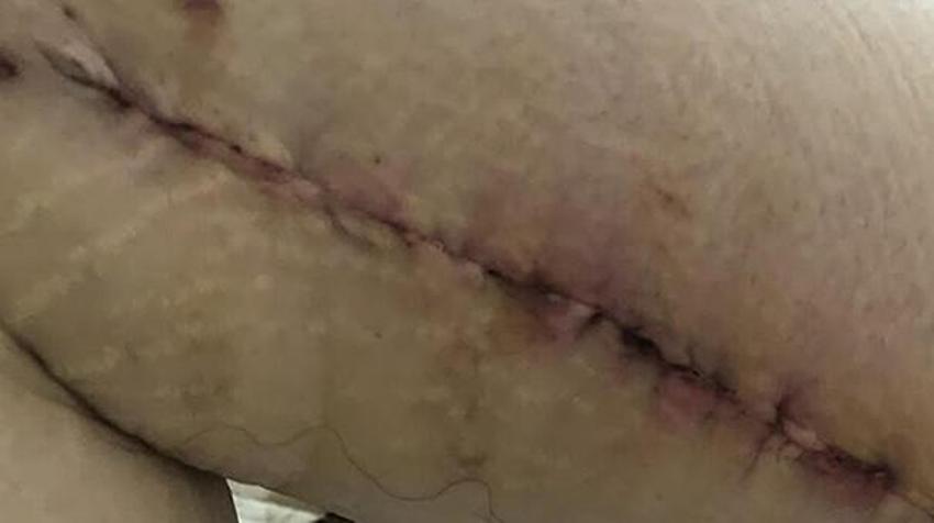 Estetik operasyon kabusu! Peş peşe 3 kez denedi, görünce kendi bile inanamadı
