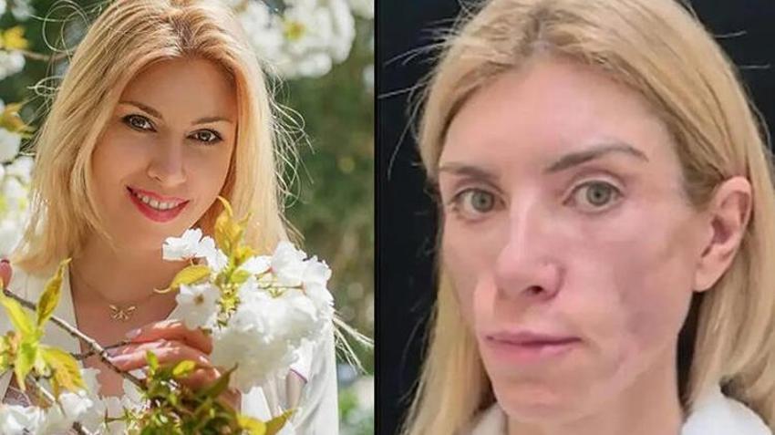 Rus güzellik kraliçesi Yulia Tarasevich’in hayatı kabus oldu! Estetik faciası...