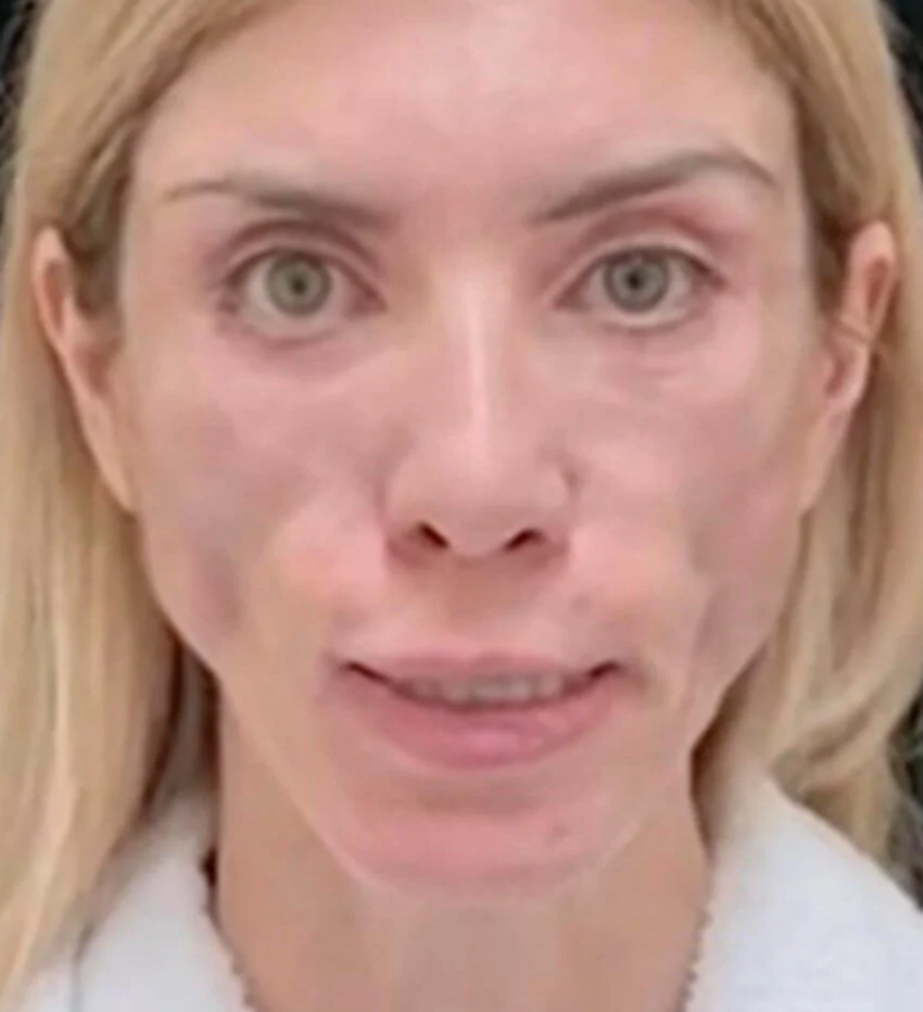 Rus güzellik kraliçesi Yulia Tarasevich’in hayatı kabus oldu! Estetik faciası...