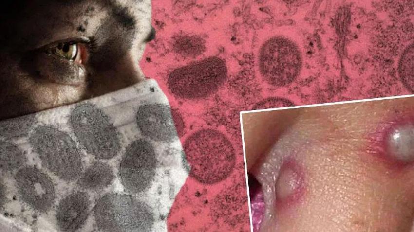 Koronavirüsten sonra kabusun yeni adı Maymun çiçeği virüsü! Bir ülkeye daha sıçradı: Flaş açıklama geldi...