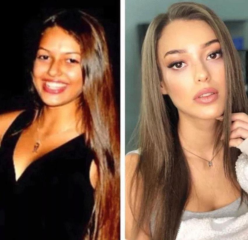 Dilan Çiçek Deniz estetik harikası çıktı! 