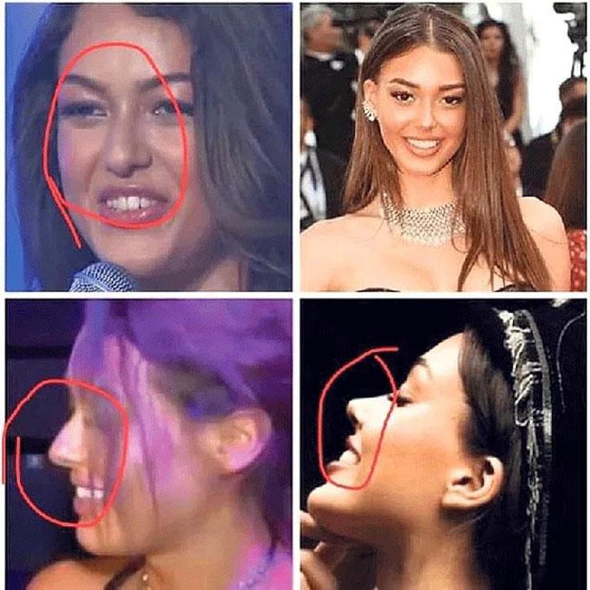 Dilan Çiçek Deniz estetik harikası çıktı! 